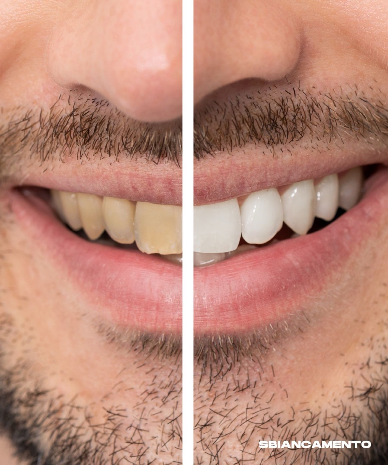 Seduta di igiene dentale professionale allo studio Dental Design